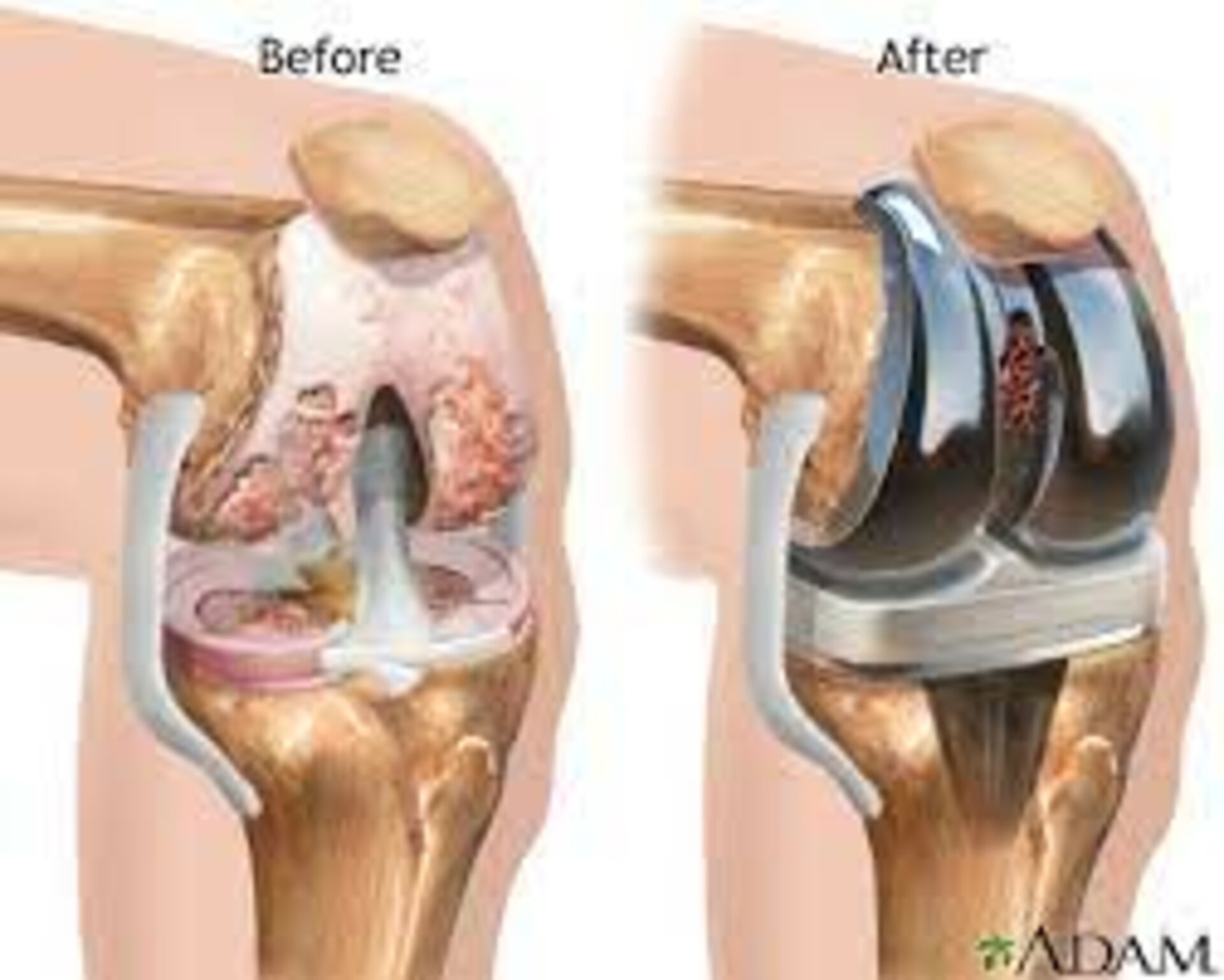 Total Knee Replacement.
